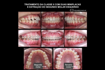 1 Vídeo EXO Segundo Molar 720P	