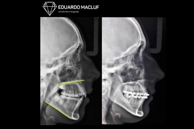 Tratamento da Classe II vertical com IZC