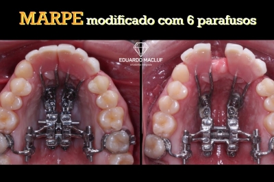 MARPE MODIFICADO com 6 parafusos para sustentar uma prótese provisória	