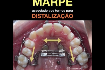 MARPE associado aos tornos para DISTALIZAÇÃO