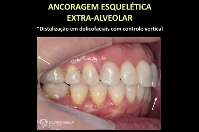 Ancoragem Esquelética Extra-Alveolar - IZC