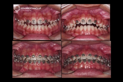 Planejamento Ortodôntico do caso limítrofe para Cirurgia Ortognática