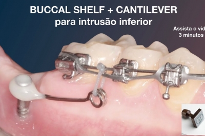 Buccal Shelf com Cantilever para intrusão de Molar Inferior